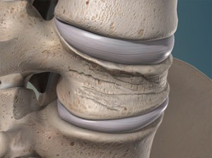What Is a Spinal Compression Fracture?